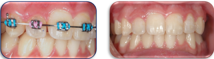 teeth with/without braces