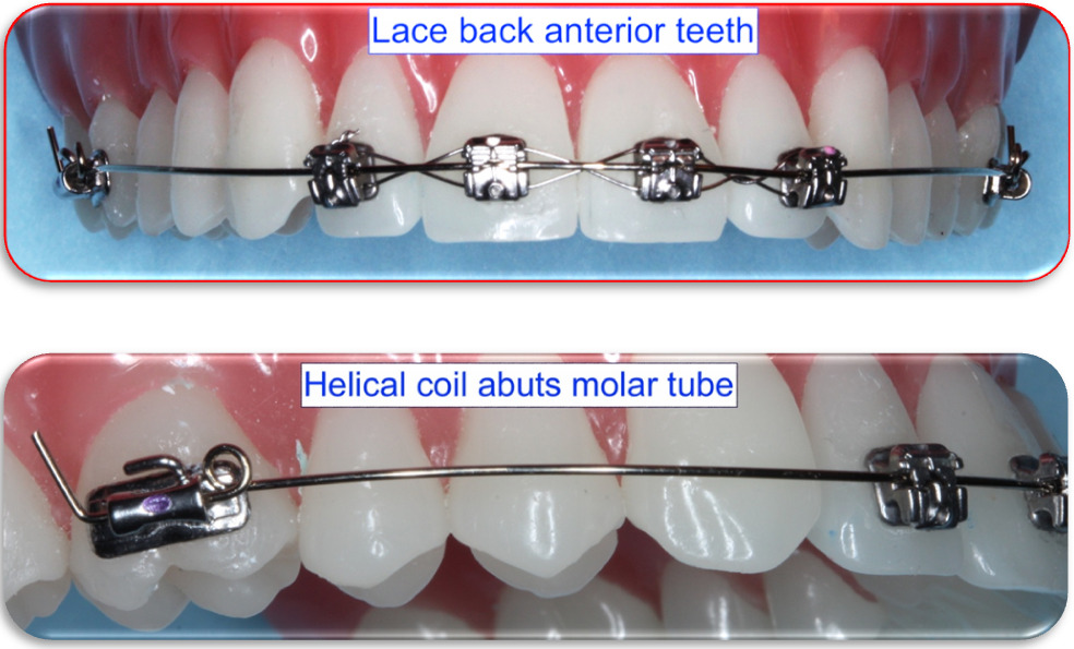 July's Tip Orthodontic Loops in Straight Wire System, Part II Helical