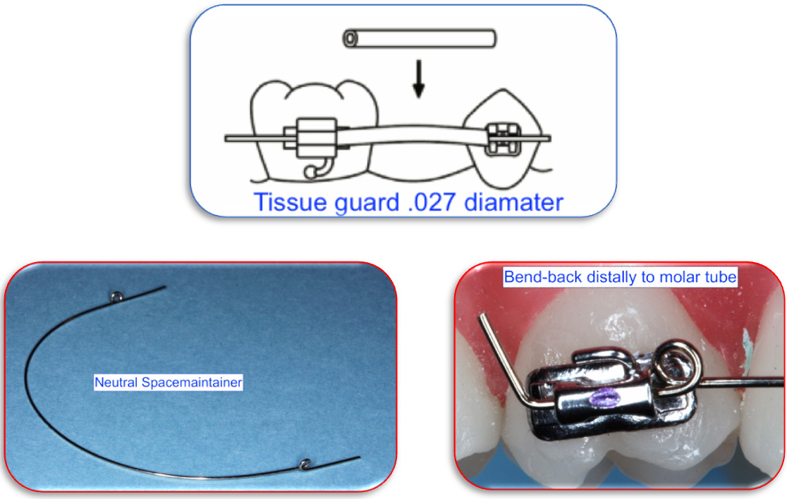 July's Tip Orthodontic Loops in Straight Wire System, Part II Helical
