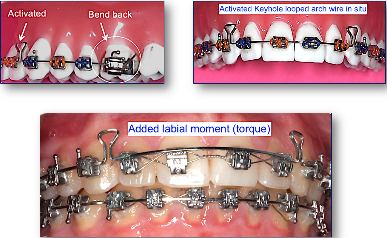 December's Tip Prefabricated Posted and Keyhole/Mushroom Looped Arch WiresWhat is it All About
